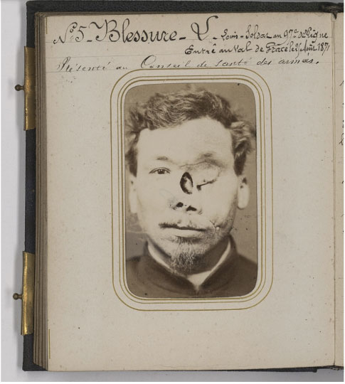 fig.1 Photographie de Louis L. blessé à Gravelotte. Album de vingt photographies sur papier albuminé, dont douze représentant des blessés de la guerre de 1870 avant et après restauration de la face, Charles DELALAIN, 1872, CISA 1190.